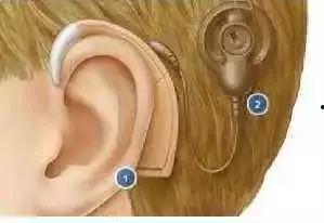 网友爆料耳蜗钉视频大全,网友爆料揭秘耳蜗植入全过程  第3张